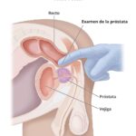 Preparación para el Examen de Próstata: Una Guía Completa